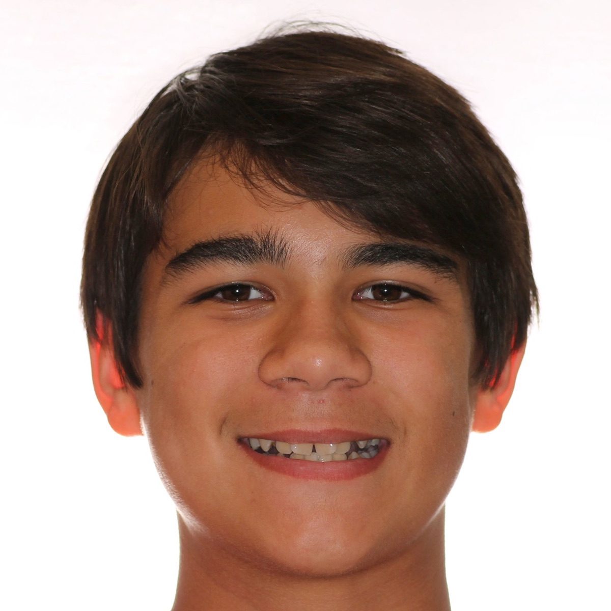 Brodie Bowman Orthodontics patient portrait taken before treatment