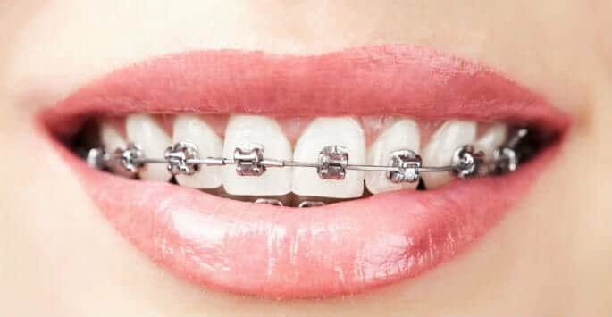 smart clip braces