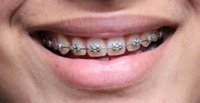 Mini diamond braces