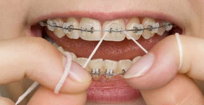 Stains from Braces