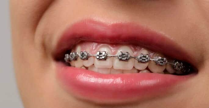 Mini braces