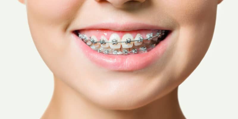 The Final Stretch: What to Expect in the Last Days of Orthodontic Treatment | Brodie Bowman Orthodontics