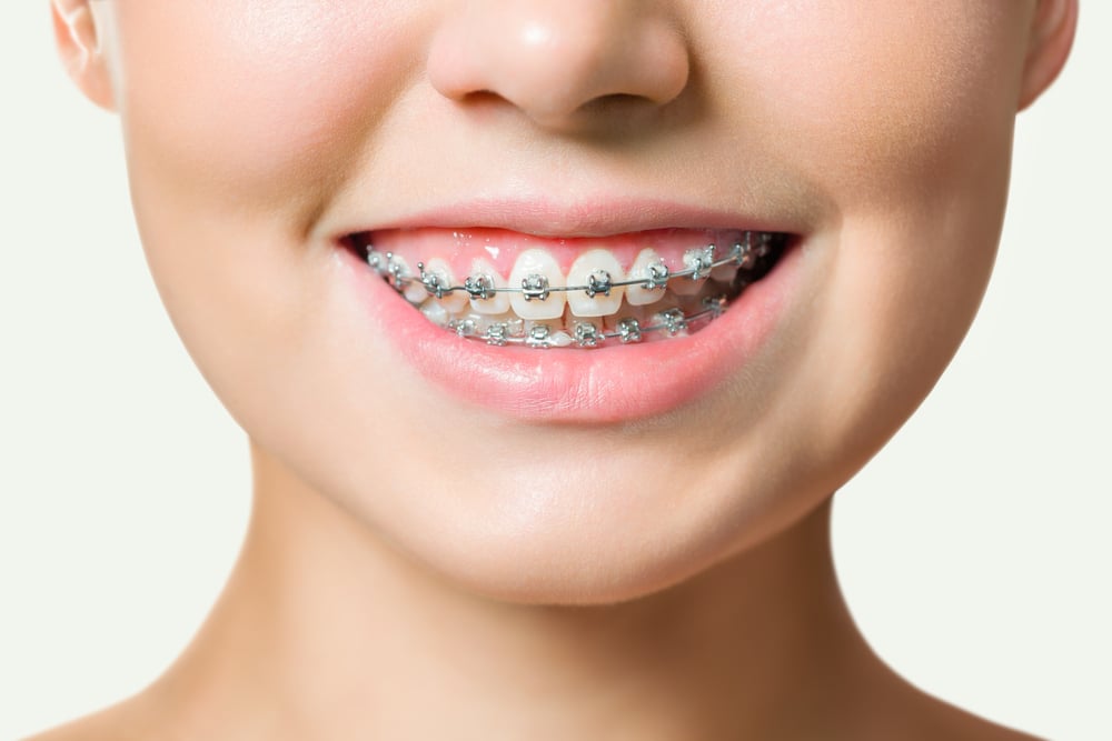 The Final Stretch: What to Expect in the Last Days of Orthodontic Treatment | Brodie Bowman Orthodontics